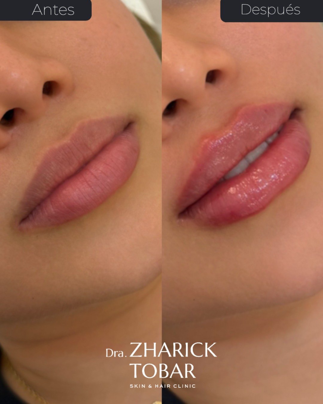 Resultado real · Perfilamiento y Aumento de Labios