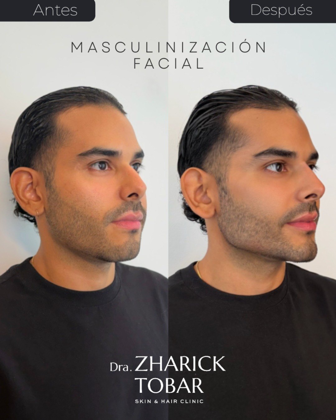 Resultado real · Marcación Mandibular