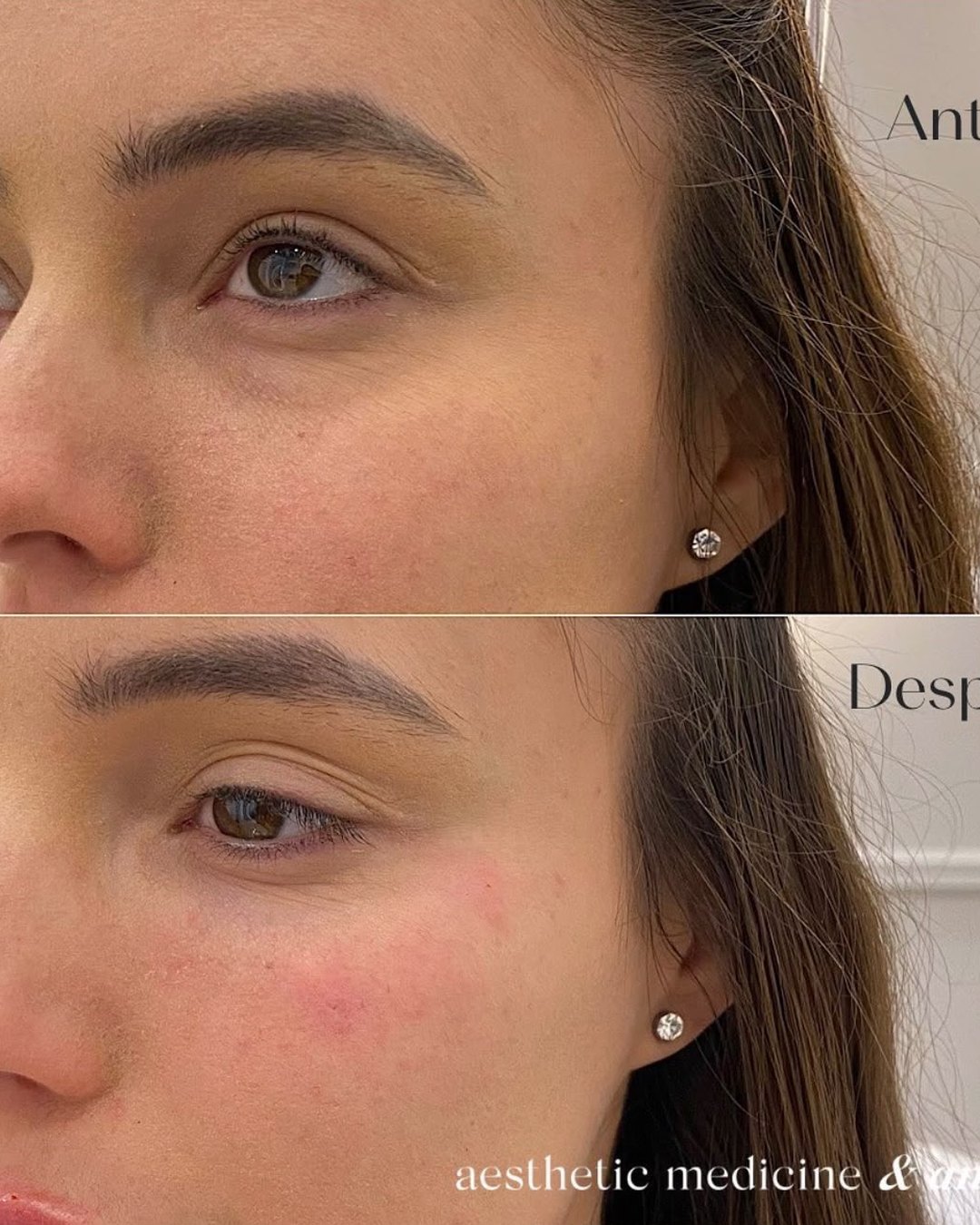 Resultado real · Tratamiento de Ojeras
